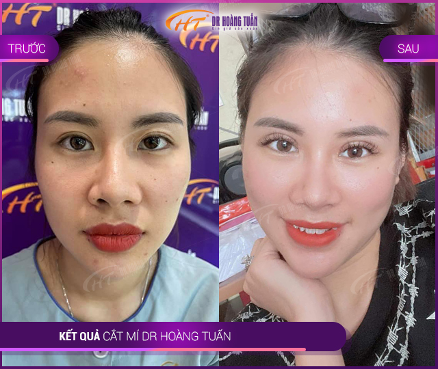 Kết quả Cắt Mí Mắt